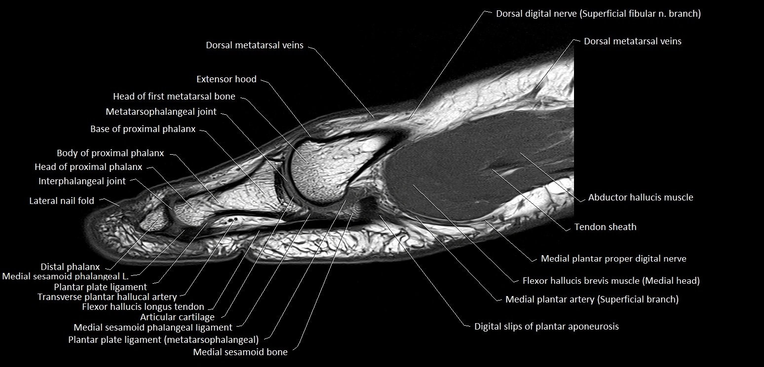 Hallux or big toe sagittal anatomy 3T MRI image 9.webp